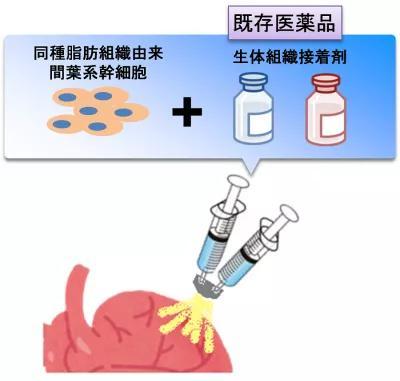 日本大阪大學研發出救治心衰患者的干細胞噴霧